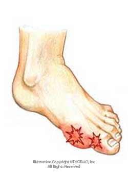 Gout Toe Pain
