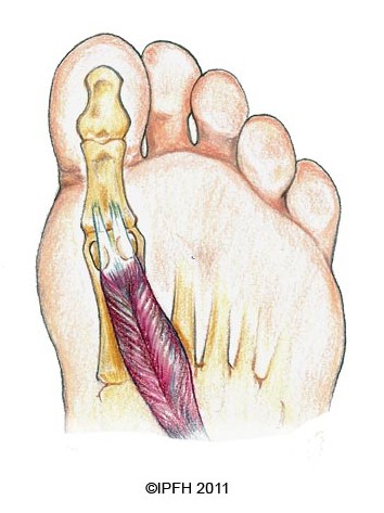 Sesamoiditis Surgery